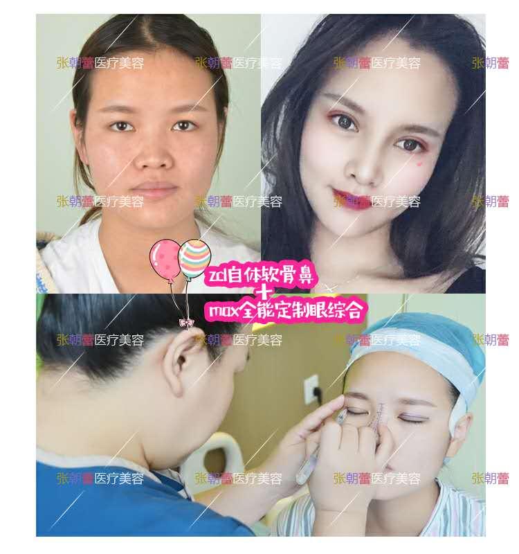 做假体鼻子视频,跟随视频学习专业技巧